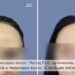 Пересадка волос для женщин в Москве — преимущества в клинике HAIR&SKIN