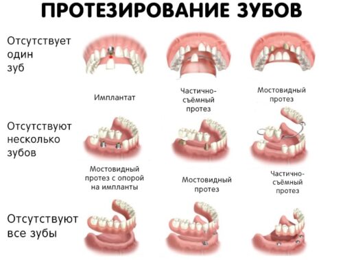Современные методы протезирования зубов
