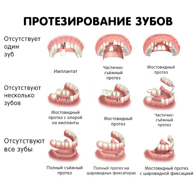 Современные методы протезирования зубов