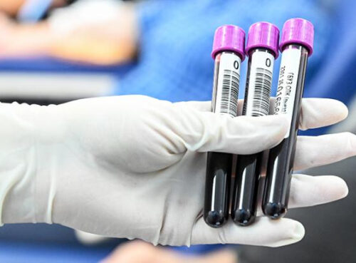 Озвучен самый простой способ выявить болезнь Альцгеймера