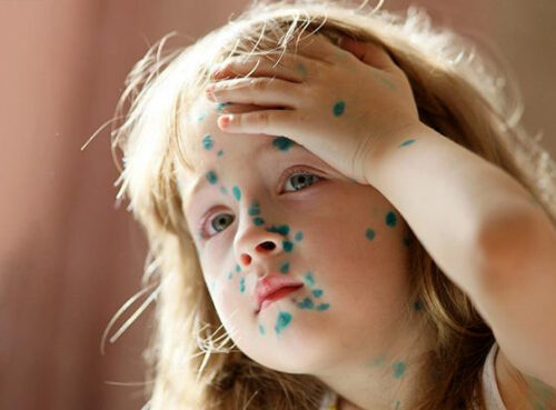 Ветряная оспа в курсе, что с «короной» Минздрав накосячил — и бесчинствует в российских регионах Ветряная оспа в курсе, что с «короной» Минздрав накосячил — и бесчинствует в российских регионах