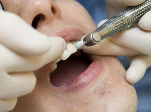 Врач рассказала, о чём может сигнализировать налёт на зубах