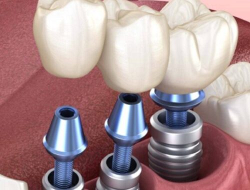 Зубные имплантаты в Ессентуках: восстановление улыбки на долгие годы
