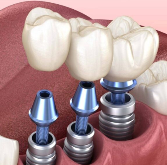 Зубные имплантаты в Ессентуках: восстановление улыбки на долгие годы