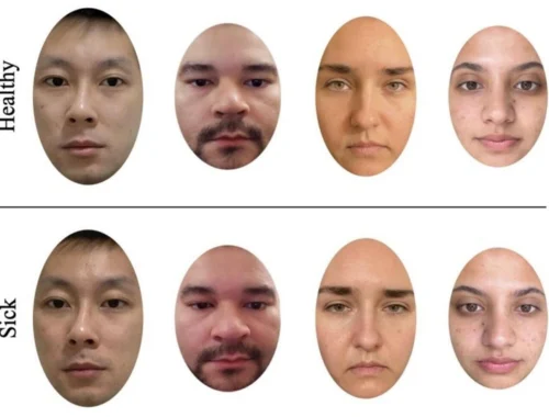 Диагноз по фотографии: женщины лучше вычислили больных по лицу Диагноз по фотографии: женщины лучше вычислили больных по лицу