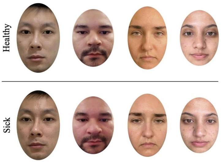 Диагноз по фотографии: женщины лучше вычислили больных по лицу