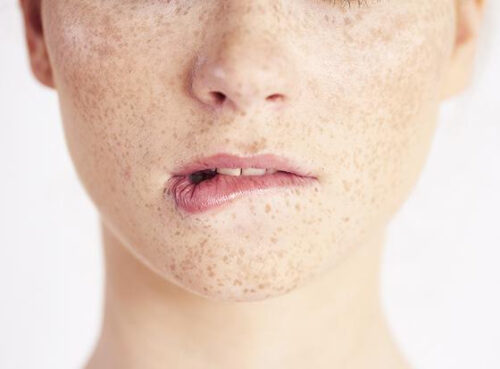 Что нужно знать о лазерной эпиляции при гиперпигментации и склонности к рубцеванию Что нужно знать о лазерной эпиляции при гиперпигментации и склонности к рубцеванию