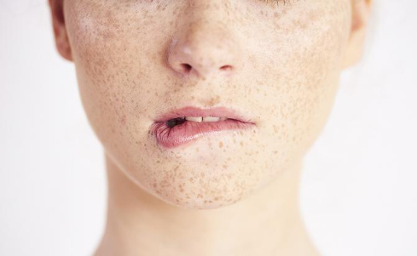 Что нужно знать о лазерной эпиляции при гиперпигментации и склонности к рубцеванию