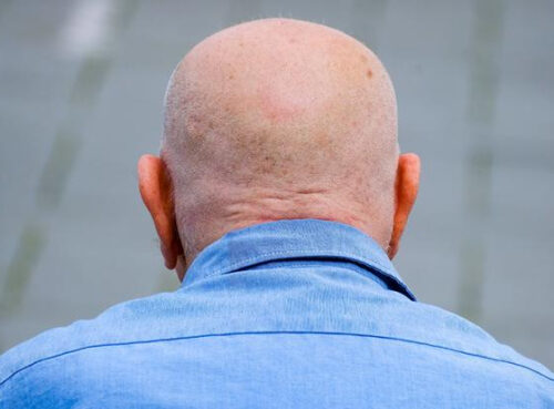 Известное растение оказалось связано с замедлением облысения