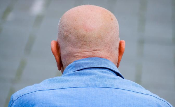 Известное растение оказалось связано с замедлением облысения