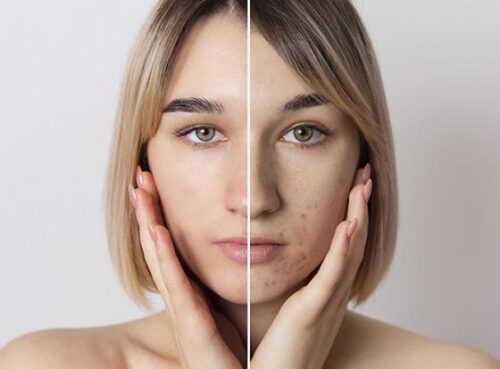 Почему стресс и нарушение сна могут вызывать акне