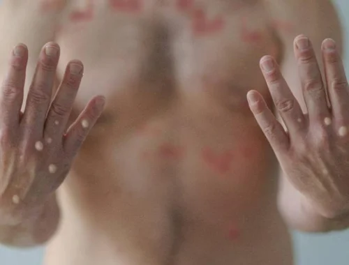 В Подмосковье госпитализировали двух человек с подозрением на оспу обезьян